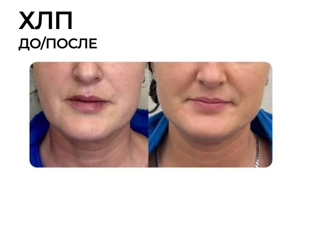 Холодный лазерный пилинг: фото результата 2